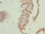 Immunohistochemistry of paraffin-embedded human breast cancer using CAC08331 at dilution of 1:100