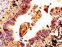 IHC image diluted at 1:400 and staining in paraffin-embedded human lung cancer performed on a Leica BondTM system. After dewaxing and hydration, antigen retrieval was mediated by high pressure in a citrate buffer (pH 6.0). Section was blocked with 10% normal goat serum 30min at RT. Then primary antibody (1% BSA) was incubated at 4°C overnight. The primary is detected by a biotinylated secondary antibody and visualized using an HRP conjugated SP system.