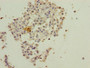 Immunohistochemistry of paraffin-embedded human breast cancer using CAC08370 at dilution of 1:100