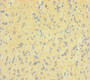 Immunohistochemistry of paraffin-embedded human glioma using CAC08371 at dilution of 1:100