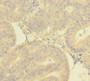 Immunohistochemistry of paraffin-embedded human endometrial cancer using CAC08373 at dilution of 1:100