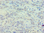 Immunohistochemistry of paraffin-embedded human breast cancer using CAC08384 at dilution of 1:100