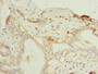 Immunohistochemistry of paraffin-embedded human breast cancer using CAC08393 at dilution of 1:100