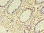 Immunohistochemistry of paraffin-embedded human colon cancer using CAC08410 at dilution of 1:100