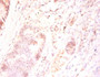 Immunohistochemistry of paraffin-embedded human colon cancer using CAC08423 at dilution of 1:50