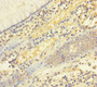 Immunohistochemistry of paraffin-embedded human colon cancer using CAC08428 at dilution of 1:100