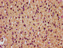 IHC image diluted at 1:200 and staining in paraffin-embedded human glioma performed on a Leica BondTM system. After dewaxing and hydration, antigen retrieval was mediated by high pressure in a citrate buffer (pH 6.0). Section was blocked with 10% normal goat serum 30min at RT. Then primary antibody (1% BSA) was incubated at 4°C overnight. The primary is detected by a biotinylated secondary antibody and visualized using an HRP conjugated SP system.