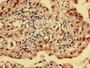 Immunohistochemistry analysis of human lung cancer using CAC08531 at dilution of 1:100