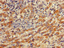 Immunohistochemistry of paraffin-embedded human liver cancer using CAC08539 at dilution of 1:100