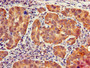 Immunohistochemistry of paraffin-embedded human pancreatic cancer using CAC08539 at dilution of 1:100