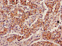 Immunohistochemistry of paraffin-embedded human lung cancer using CAC08557 at dilution of 1:100