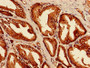 Immunohistochemistry of paraffin-embedded human prostate cancer using CAC08601 at dilution of 1:100