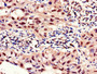 Immunohistochemistry of paraffin-embedded human lung cancer using CAC08717 at dilution of 1:100