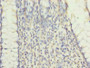 Immunohistochemistry of paraffin-embedded human colon cancer using CAC08805 at dilution of 1:100