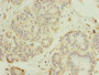 Immunohistochemistry of paraffin-embedded human breast cancer using CAC08805 at dilution of 1:100