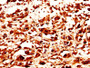 IHC image diluted at 1:200 and staining in paraffin-embedded human melanoma performed on a Leica BondTM system. After dewaxing and hydration, antigen retrieval was mediated by high pressure in a citrate buffer (pH 6.0). Section was blocked with 10% normal goat serum 30min at RT. Then primary antibody (1% BSA) was incubated at 4°C overnight. The primary is detected by a biotinylated secondary antibody and visualized using an HRP conjugated SP system.