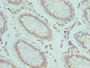 Immunohistochemistry of paraffin-embedded human colon cancer using CAC08848 at dilution of 1:100