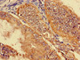 Immunohistochemistry of paraffin-embedded human endometrial cancer using CAC08849 at dilution of 1:100