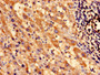 Immunocytochemistry analysis of human liver cancer using CAC08863 at dilution of 1:100