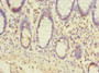 Immunohistochemistry of paraffin-embedded human colon cancer using CAC08932 at dilution of 1:100