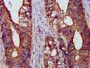 IHC image diluted at 1:1200 and staining in paraffin-embedded human colon cancer performed on a Leica BondTM system. After dewaxing and hydration, antigen retrieval was mediated by high pressure in a citrate buffer (pH 6.0). Section was blocked with 10% normal goat serum 30min at RT. Then primary antibody (1% BSA) was incubated at 4°C overnight. The primary is detected by a biotinylated secondary antibody and visualized using an HRP conjugated SP system.