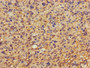 Immunohistochemistry of paraffin-embedded human glioma using CAC09077 at dilution of 1:100