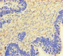 Immunohistochemistry of paraffin-embedded human ovarian cancer using CAC09081 at dilution of 1:100