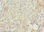 Immunohistochemistry of paraffin-embedded human liver cancer using CAC09082 at dilution of 1:100