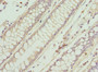 Immunohistochemistry of paraffin-embedded human colon cancer using CAC09082 at dilution of 1:100