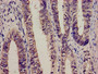 Immunohistochemistry analysis of human colon cancer using CAC09129 at dilution of 1:100