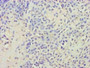 Immunohistochemistry of paraffin-embedded human breast cancer using CAC09136 at dilution of 1:100