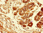 Immunohistochemistry of paraffin-embedded human breast cancer using CAC09140 at dilution of 1:100