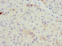 Immunohistochemistry of paraffin-embedded human liver cancer using CAC09152 at dilution of 1:100