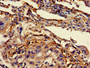Immunohistochemistry of paraffin-embedded human lung cancer using CAC09162 at dilution of 1:100