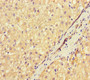 Immunohistochemistry of paraffin-embedded human liver cancer using CAC09199 at dilution of 1:100