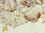 Immunohistochemistry of paraffin-embedded human breast cancer using CAC09282 at dilution of 1:100