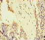 Immunohistochemistry of paraffin-embedded human lung cancer using CAC09298 at dilution of 1:100