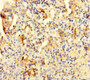 Immunohistochemistry of paraffin-embedded human lung cancer using CAC09299 at dilution of 1:100