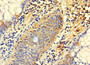 Immunohistochemistry of paraffin-embedded human colon cancer using CAC09339 at dilution of 1:100