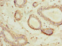 Immunohistochemistry of paraffin-embedded human breast cancer using CAC09340 at dilution of 1:100