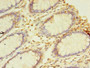 Immunohistochemistry of paraffin-embedded human colon cancer using CAC09355 at dilution of 1:100