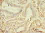 Immunohistochemistry of paraffin-embedded human breast cancer using CAC09355 at dilution of 1:100