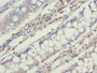 Immunohistochemistry of paraffin-embedded human colon cancer using CAC09359 at dilution of 1:100