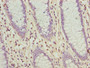 Immunohistochemistry of paraffin-embedded human colon cancer using CAC09385 at dilution of 1:100