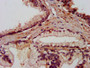 IHC image diluted at 1:800 and staining in paraffin-embedded human prostate cancer performed on a Leica BondTM system. After dewaxing and hydration, antigen retrieval was mediated by high pressure in a citrate buffer (pH 6.0). Section was blocked with 10% normal goat serum 30min at RT. Then primary antibody (1% BSA) was incubated at 4°C overnight. The primary is detected by a biotinylated secondary antibody and visualized using an HRP conjugated SP system.