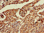 Immunohistochemistry of paraffin-embedded human lung cancer using CAC09531 at dilution of 1:100