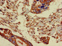 Immunohistochemistry of paraffin-embedded human pancreatic cancer using CAC09531 at dilution of 1:100