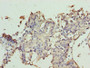 Immunohistochemistry of paraffin-embedded human breast cancer using CAC09534 at dilution of 1:100