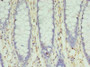 Immunohistochemistry of paraffin-embedded human colon cancer using CAC09558 at dilution of 1:100