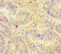 Immunohistochemistry of paraffin-embedded human colon cancer using CAC09600 at dilution of 1:100